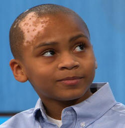 [تصویر: vitiligo_young_boy.jpg]