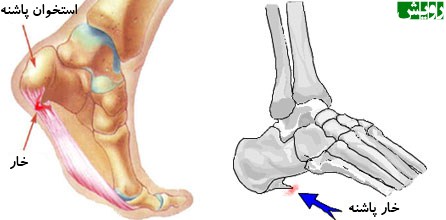 خار پاشنه - mahu.ir