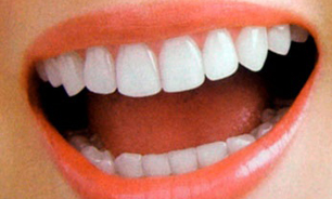 چطوری دندانهای سفیدی داشته باشیم 1