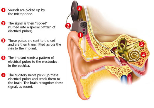 ایمپلنت حلزونی گوش