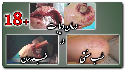 معجزه طب سنتی در درمان دیابت