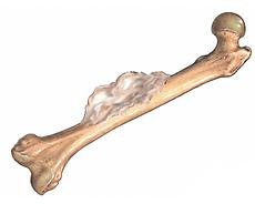 سرطان استخوان (Bone Cancer)