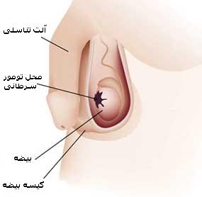 سرطان بیضه / Testicular Cancer